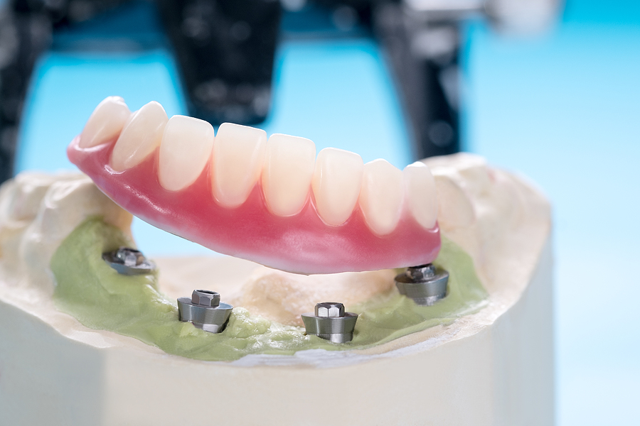 Image for All-on-4® Dental Implants Image for All-on-4® Dental Implants