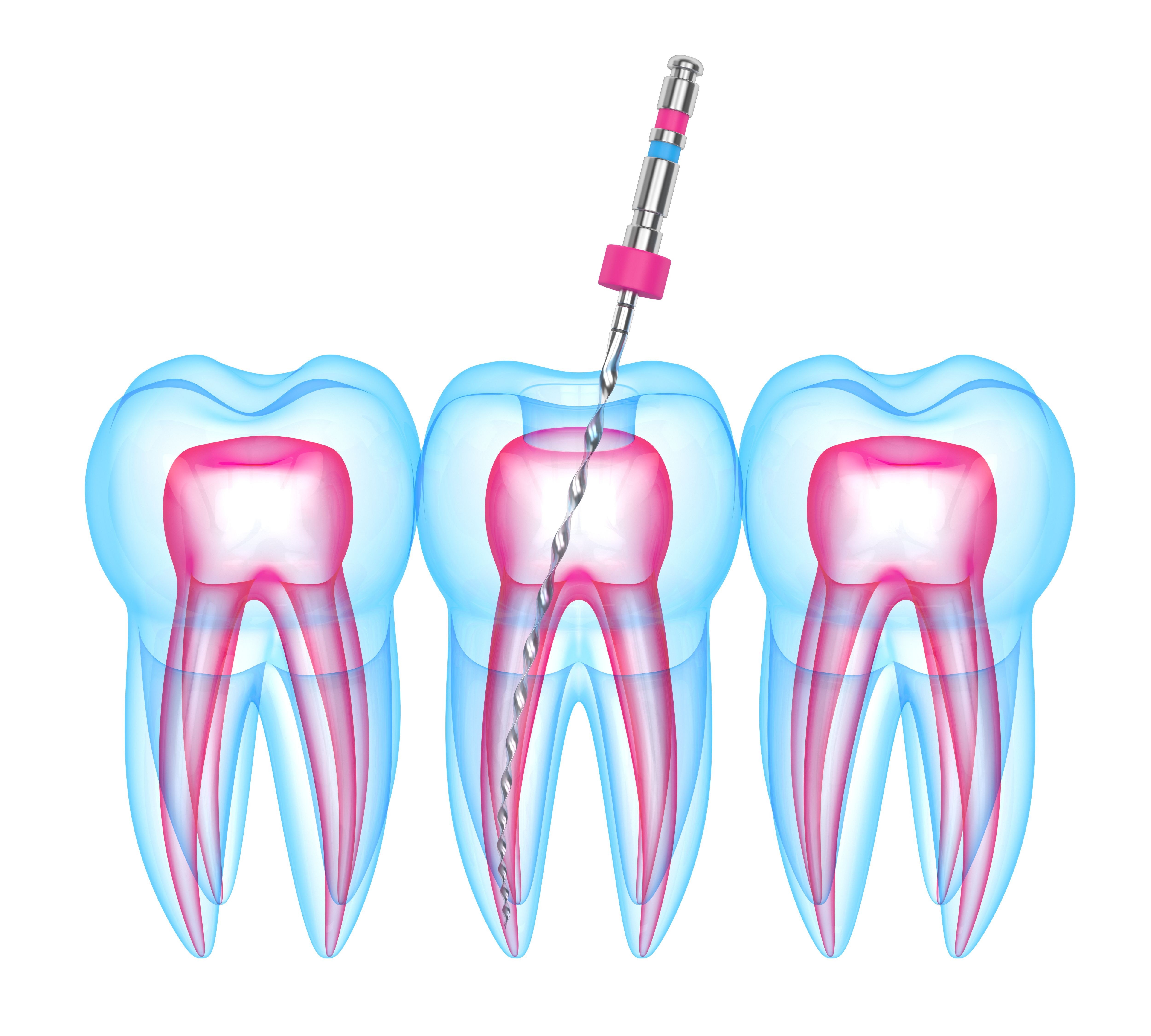 image for gentle root canal therapy