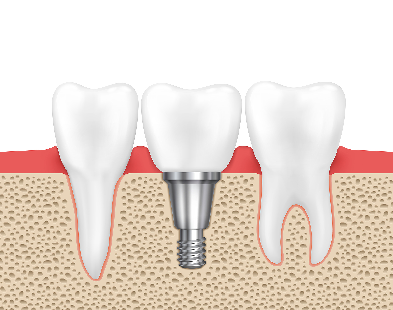 image for Dental Implant Restorations image for Dental Implant Restorations
