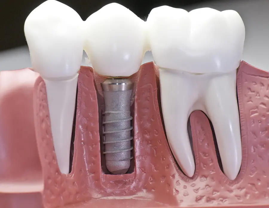 image for Dental Implants image for Dental Implants