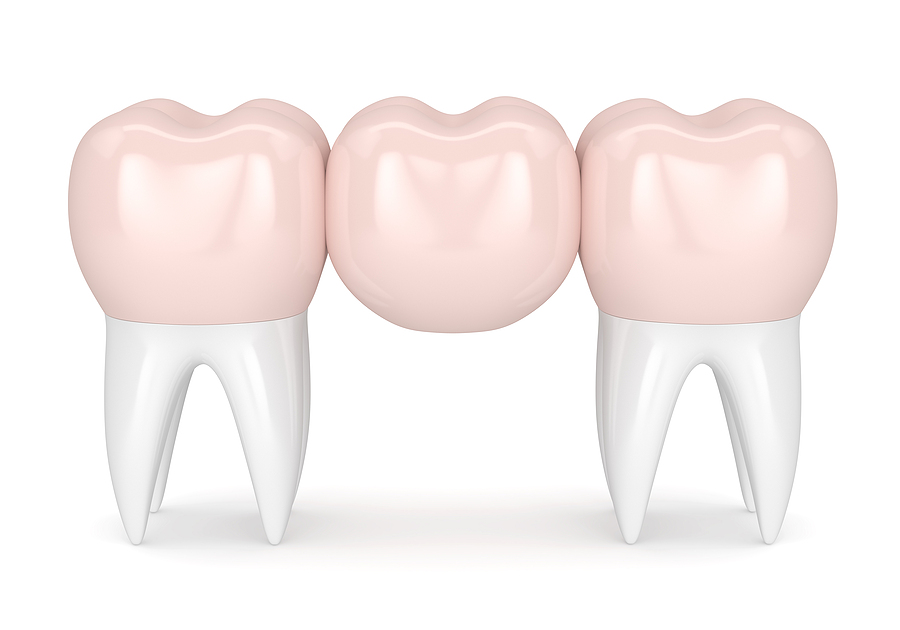 img for Dental Bridges img for Dental Bridges