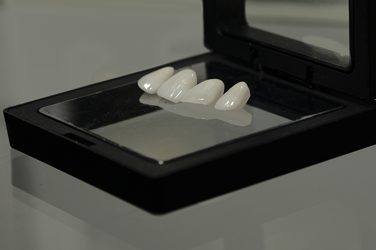image for Dental Veneers